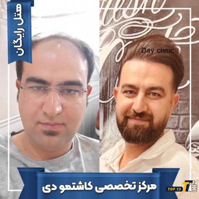 کلینیک کاشت مو دی - تاپ 13 مرجع معرفی برترین های ایران