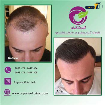 کلینیک کاشت مو آریان