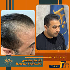 کلینیک هیوا - بهترین کلینیک کاشت مو مازندران